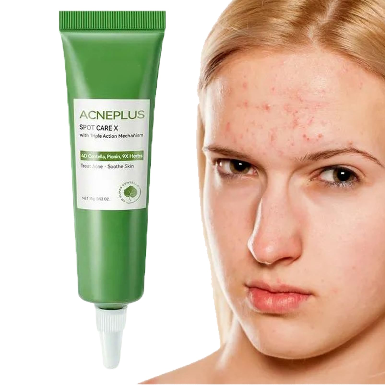 best steroid cream for face